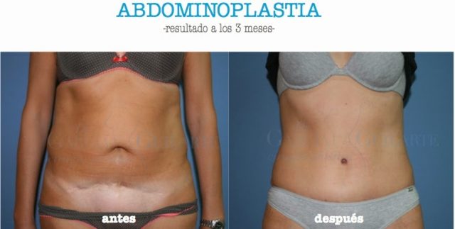 abdominoplastia_madrid_cirujano_plastico abdominoplastia madrid