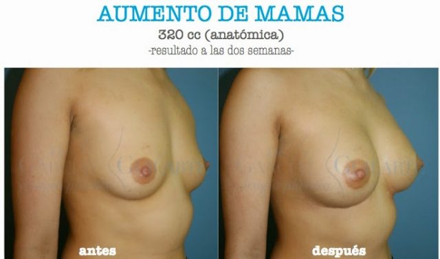 AUMENTO-DE-MAMAS.1431