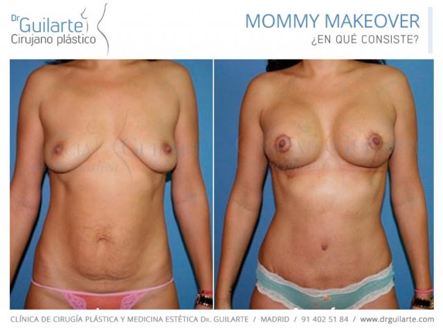 Mommy Makeover Madrid, el mejor cirujano plástico Dr Guilarte Mommy Makeover Madrid, el mejor cirujano plástico Dr Guilarte
