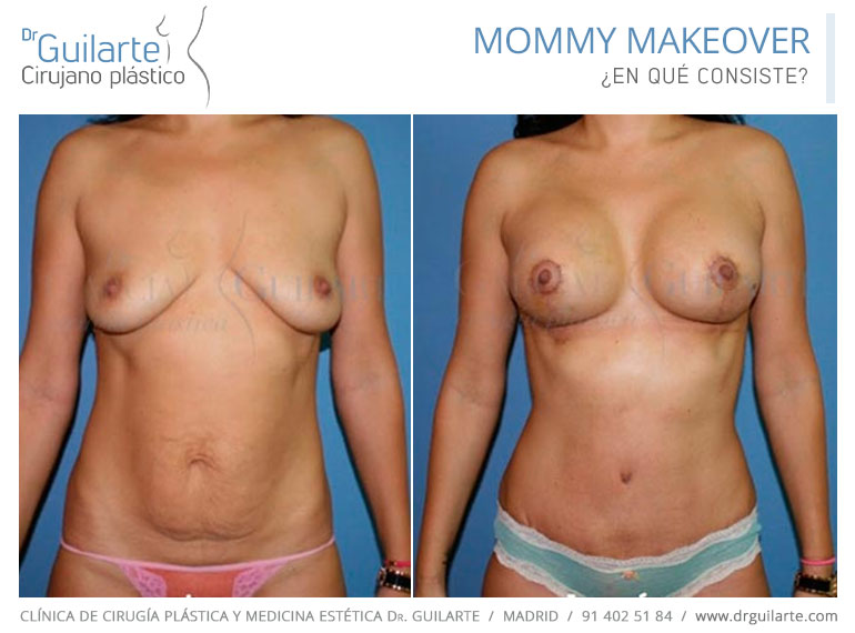 Mommy Makeover Madrid, el mejor cirujano plástico Dr Guilarte Mommy Makeover Madrid, el mejor cirujano plástico Dr Guilarte