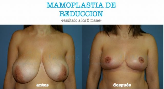 reduccion_pecho_mamas_madrid