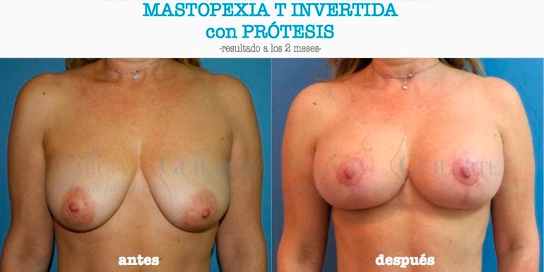 Perder-volumen-tras-aumento-pecho-imagen-destacada resultados mastopexia t invertida con protesis