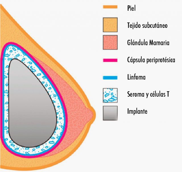 linfoma_implantes_protesis_mama_mamarias linfoma en implantes de protesis mamarias