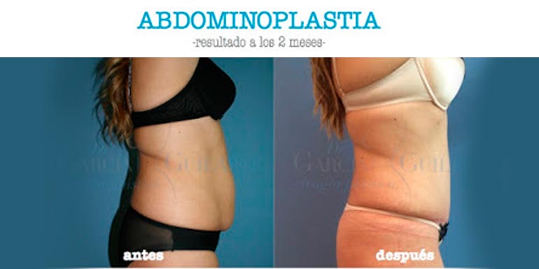 abdominoplastia_imagen_destacada imagen resultado abdominoplastia