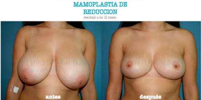 mamoplastia_reduccion_imagen_destacada imagen resultados mamoplastia reduccion