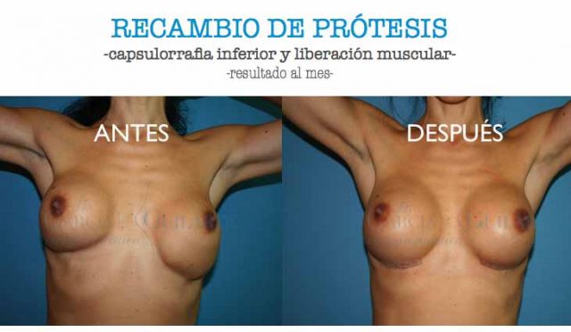 RECAMBIO PROTESIS.004-001
