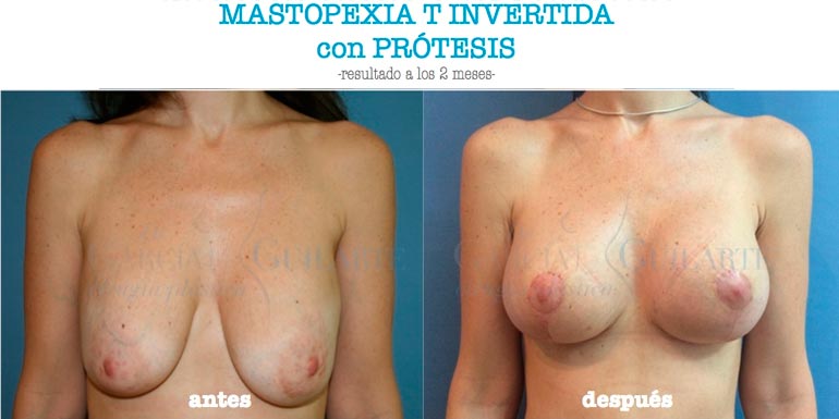 recambio-protesis-imagen-destacada Imagen destacada de recambio protesis