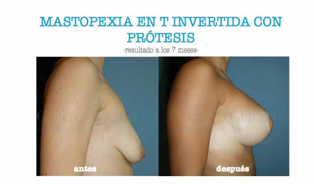 aumento pecho y mastopexia cirujano madrid