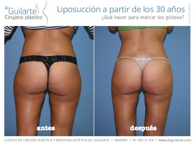Liposucción a partir de los 30 años, ¿qué hacer para marcar gúlteos? Liposucción, lipoescultura, lipofilling Liposucción a partir de los 30 años, ¿qué hacer para marcar gúlteos? Liposucción, lipoescultura, lipofilling