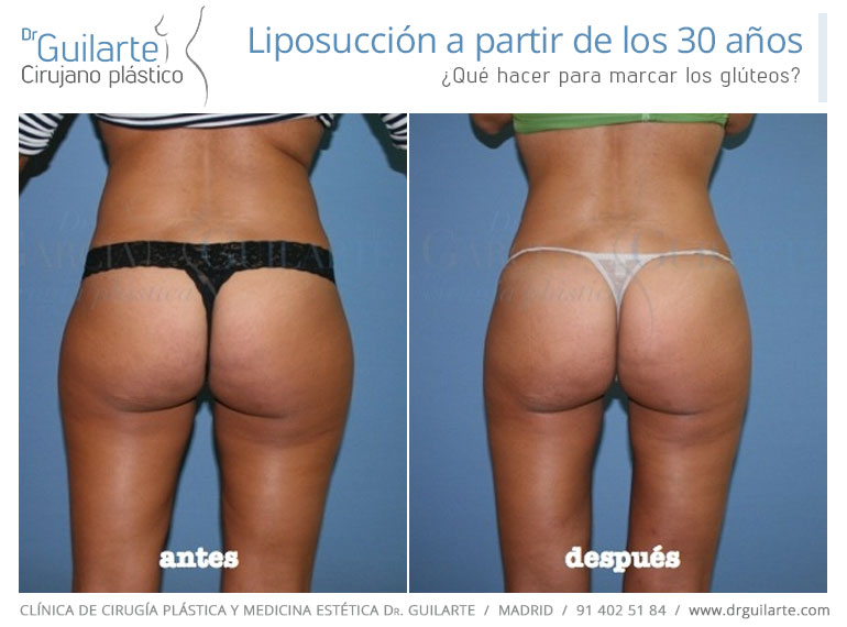 Liposucción a partir de los 30 años, ¿qué hacer para marcar gúlteos? Liposucción, lipoescultura, lipofilling Liposucción a partir de los 30 años, ¿qué hacer para marcar gúlteos? Liposucción, lipoescultura, lipofilling