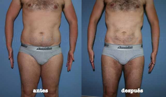 liposuccion masculina lipoescultura madrid