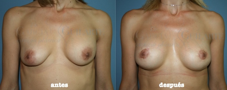 recambio implantes madrid recambio implantes madrid
