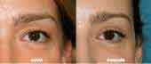 blefaroplastia parpados cirujano plastico
