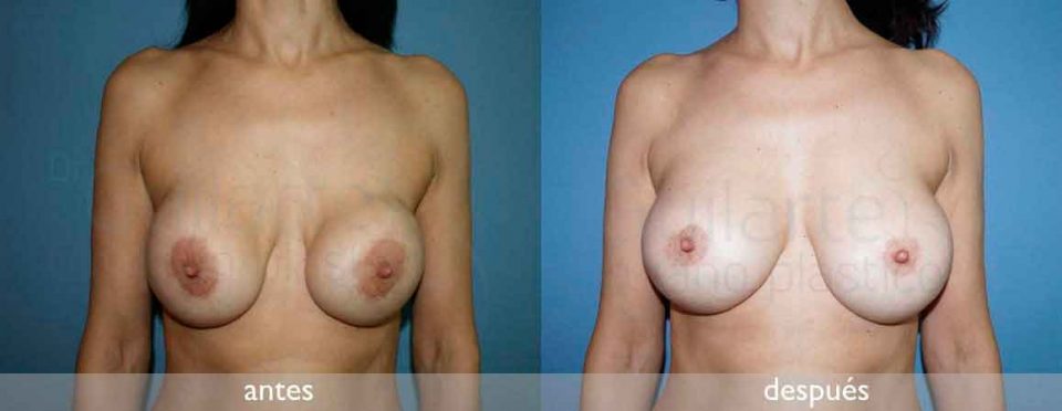 Las mejores cirugías de pecho en Madrid. Arreglo pecho con protesis, recambio protesis con capsulectomía, cambio a submuscular y cambio de implantes