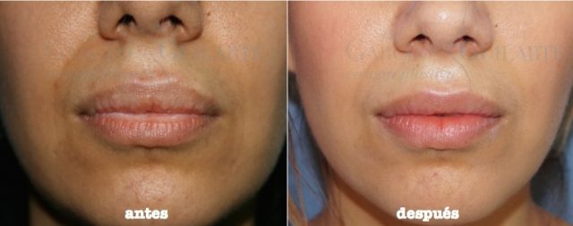 Quitar la silicona de los labios