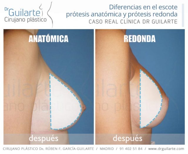Comparativa entre prótesis anatómica y prótesis redonda: el aspecto de la mama con un implante redondo será más de semiesfera o de pera con uno anatómico pero con una forma igualmente natural en la zona más superior