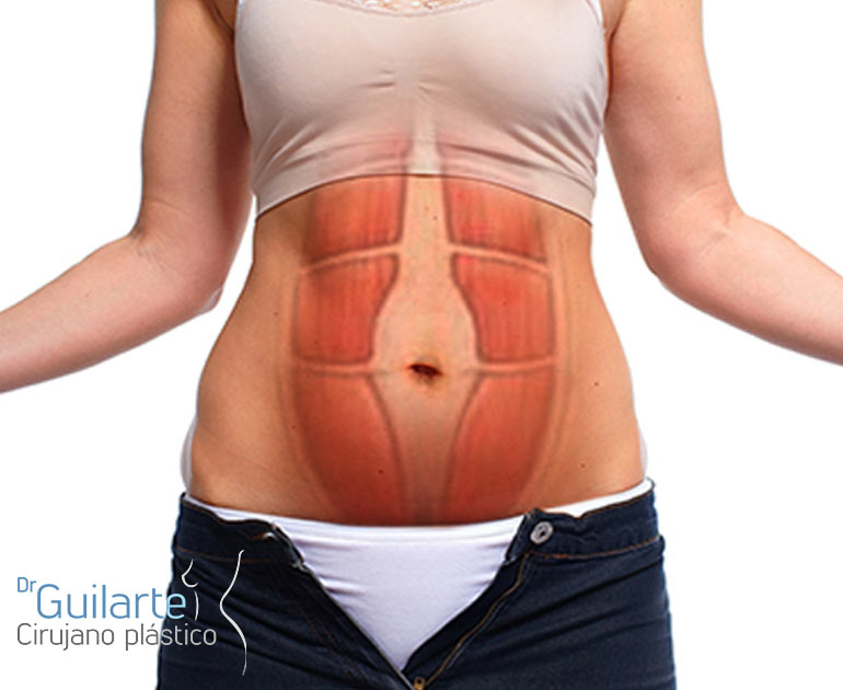 Diástasis de los músculos rectos del abdomen. Solución: abdominoplastia Diástasis de los músculos rectos del abdomen. Solución: abdominoplastia