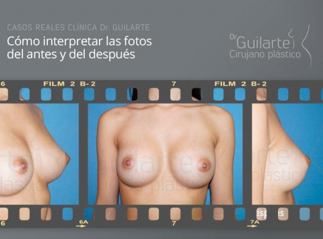 Cómo interpretar las fotos del aumento de pecho antes y después