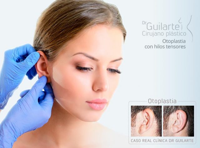 Otoplastia con hilos tensores ¿Qué es y en qué consiste?