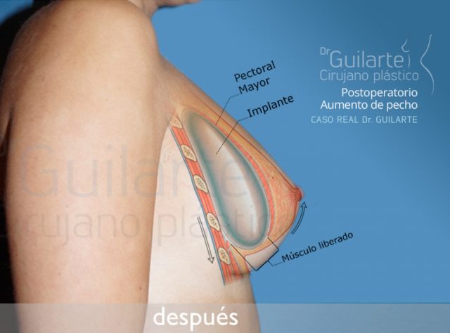 Postoperatorio de aumento de senos submuscular. Gráfico de implante en posición submuscular