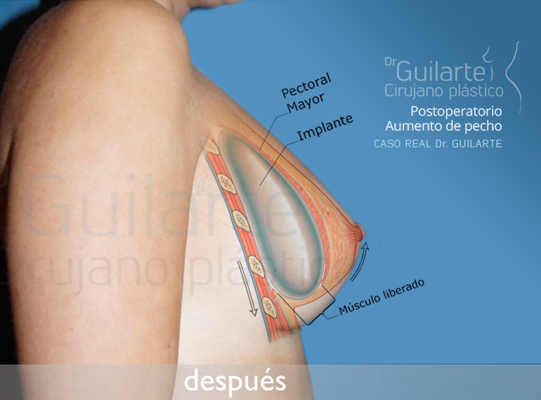 Postoperatorio de aumento de senos submuscular. Gráfico de implante en posición submuscular Postoperatorio de aumento de senos submuscular. Gráfico de implante en posición submuscular
