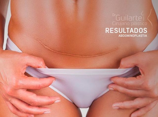 Abdominoplastia, resultados finales operación de cirugía del abdomen, cicatrices y dolor Abdominoplastia, resultados finales operación de cirugía del abdomen, cicatrices y dolor
