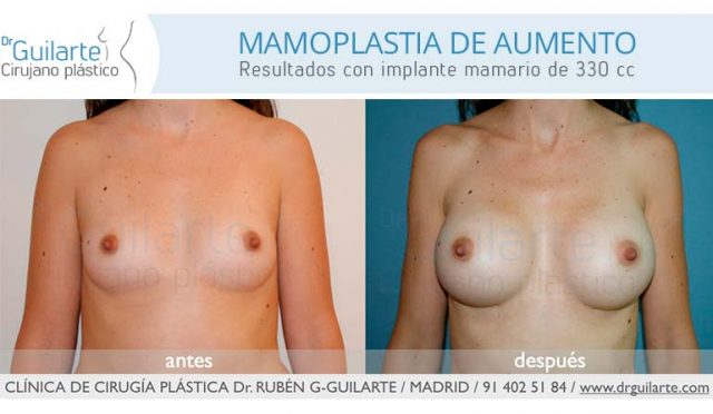 Mejor cirujano plástico Dr Guilarte. Mejores resultados de aumento de pecho en Madrid