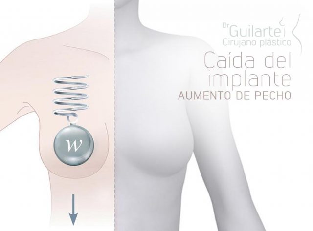 Caída del implante después del aumento de pecho. Problema aumento mamario subglandular. Efecto bottomingout. Caída del implante después del aumento de pecho. Problema aumento mamario subglandular. Efecto bottomingout.