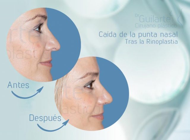 Caída de la Punta nasal tras la Rinoplastia