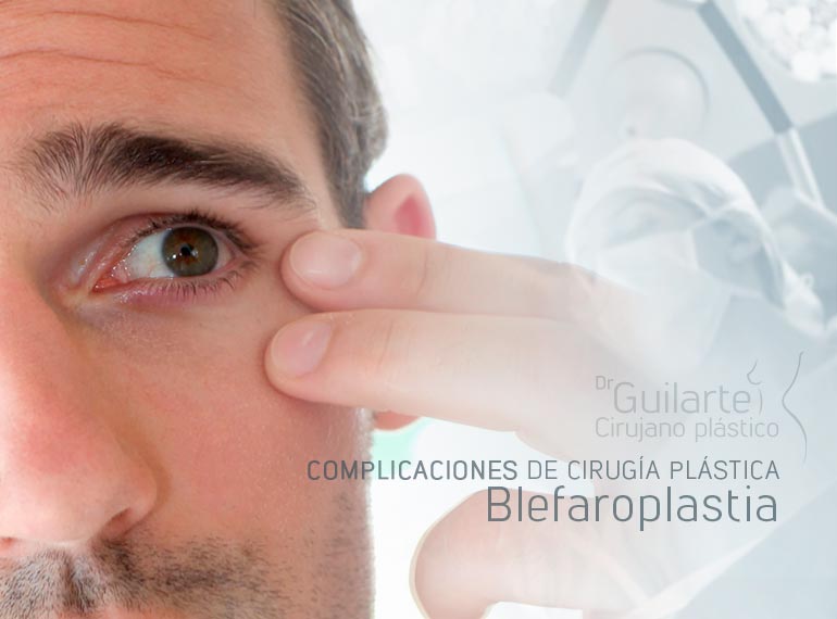 Complicaciones blefaroplastia Complicaciones blefaroplastia. Problemas cirugía plástica y trastornos