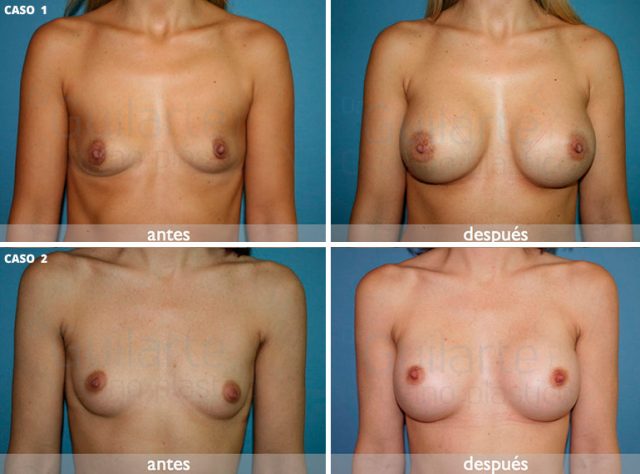 Pequeñas asimetrías de mama ¿Debo hacer algo más que un simple aumento de pecho? Casos reales clínica Madrid tratados por el Dr. Guilarte