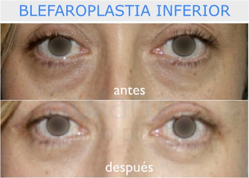 Blefaroplastia inferior transconjuntival Madrid