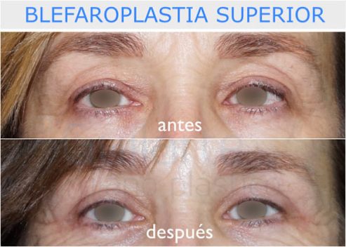 Blefaroplastia superior Dr Guilarte