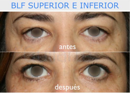 Blefaroplastia superior e inferior. Cirugía plástica Madrid
