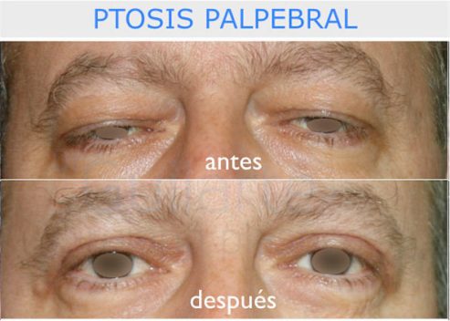 Blefaroplastia: Ptosis Palpebral. Caso clínica Dr Guilarte, Madrid