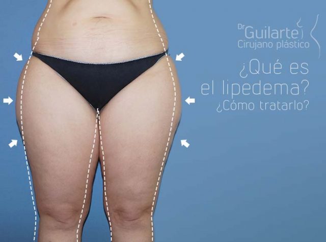 Qué es el lipedema o piernas de elefante, celulitis, tratamiento