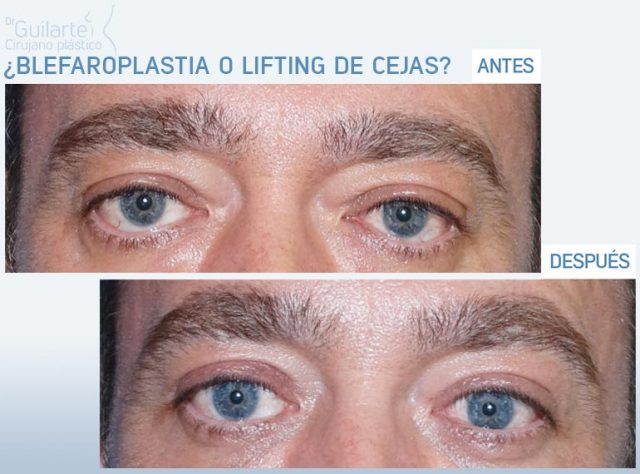 ¿Blefaroplastia o Lifting de cejas? Cirugía plástica Madrid