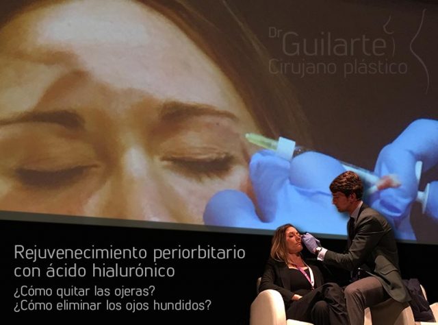 Rejuvenecimiento con ácido hialurónico para quitar las ojeras y/o eliminar los ojos hundidos