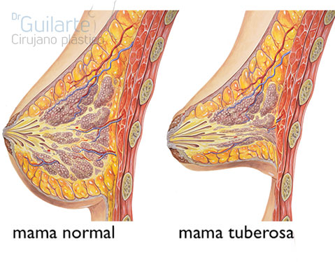 Foto diferencia entre una mama normal y una mama tuberosa a nivel interno. Recurso gráfico cirujano plástico Dr Guilarte.