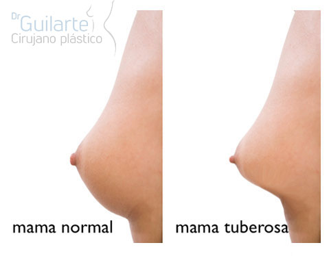Imagen diferencia entre una mama normal y una mama tuberosa a nivel externo. Graficos cirujano plástico Dr Guilarte.