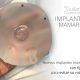 Nuevos implantes mamarios con fijación para evitar su rotación