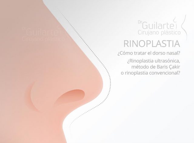 Rinoplastia: cómo tratar el dorso nasal. Rinoplastia ultrasonica o metodo Baris Çakir