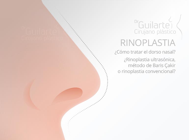 Rinoplastia: cómo tratar el dorso nasal. Rinoplastia ultrasonica o metodo Baris Çakir Rinoplastia: cómo tratar el dorso nasal. Rinoplastia ultrasonica o metodo Baris Çakir