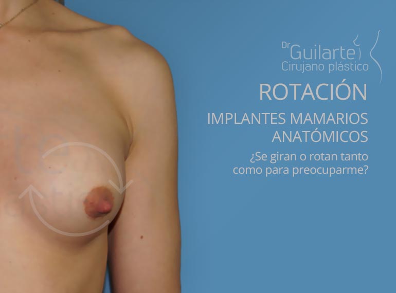 Rotación de implante mamarios anatómicos. Giro y rotación de la prótesis de pecho Rotación de implante mamarios anatómicos. Giro y rotación de la prótesis de pecho. Soluciones Clínica Guilarte