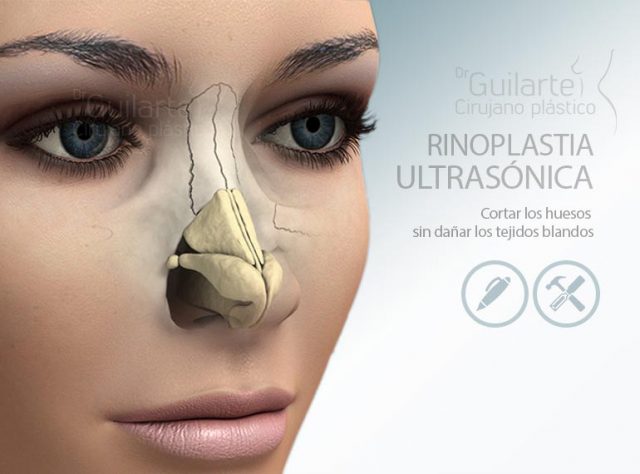 Rinoplastia ultrasónica en Madrid, lo último en cirugía de la nariz