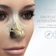 Rinoplastia ultrasónica en Madrid, lo último en cirugía de la nariz