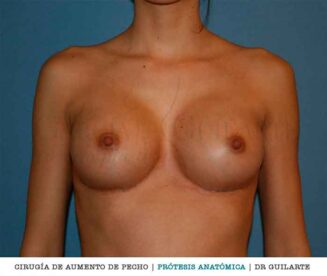 Aumento de pecho con prótesis anatómicas. Implantes mamarios