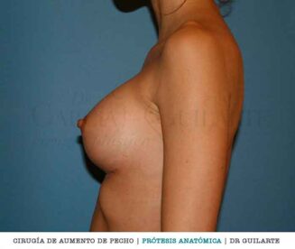 Aumento de pecho con prótesis anatómicas. Implantes mamarios