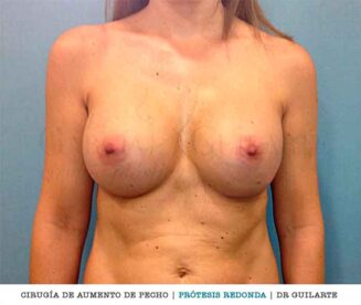 Aumento de pecho con prótesis redondas. Implantes mamarios