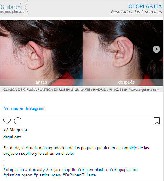 cirugía plástica niños y adolescentes: operar y eliminar el complejo de las orejas en soplillo
